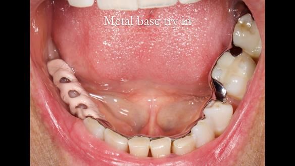 Finlay's Newsletter 61 provision of a lower unilateral free end saddle metal based partial denture for Joyce