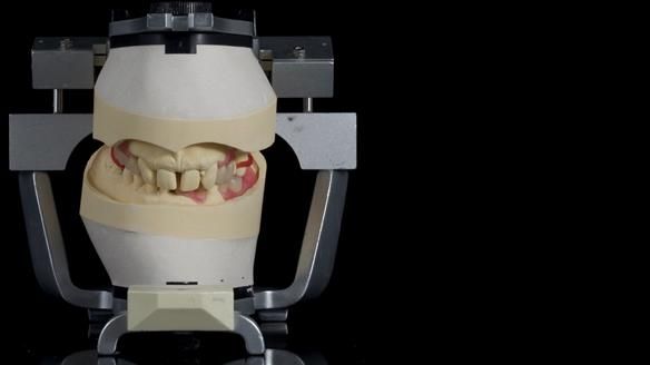 Newsletter 86 Peter the Architect — precision removable partial dentures case study