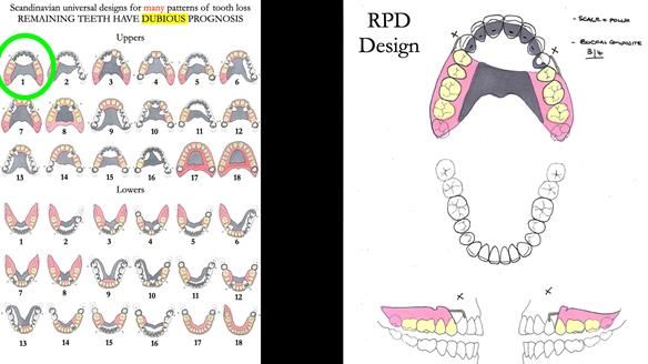 Newsletter 56 showing the making and fitting of a bilateral free end saddle upper removable partial denture (RPD) for patient with pemphigus