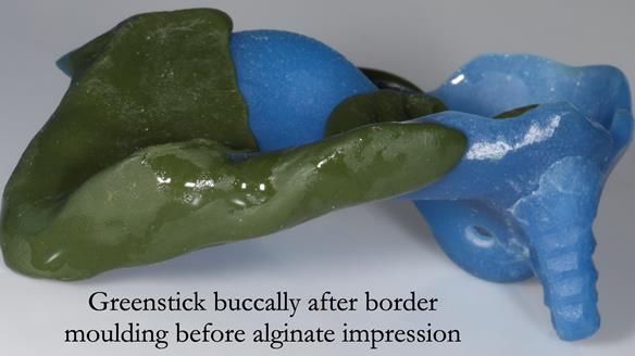 Newsletter 55 Provision of metal based partial dentures for Zephyrine with a repaired cleft lip and palate