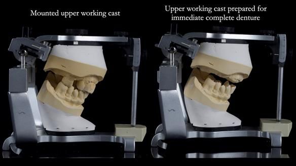 Newsletter 77: Jeremy’s case – immediate complete upper denture