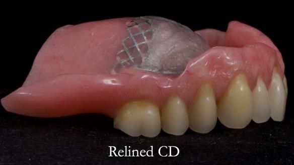 Finlay's Newsletter 62 provision of extractions and metal based complete dentures for Rafique