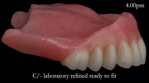 Newsletter 52 Managing Jo’s failing dentition with extractions and Mk 1/Mk 2 complete upper dentures and lower partial dentures FULL PROTOCOL