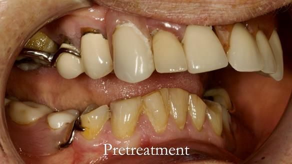 Eileen's transformation with upper and lower RPDs of Scandinavian hygienic design FULL PROTOCOL