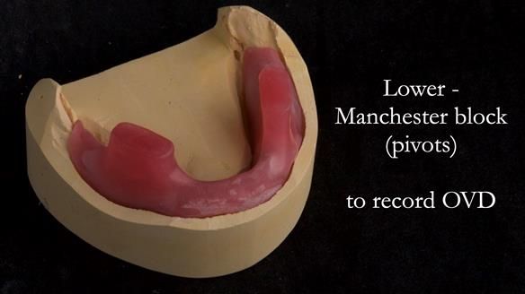 Complete denture Class II div 2 deep overbite Newsletter 39