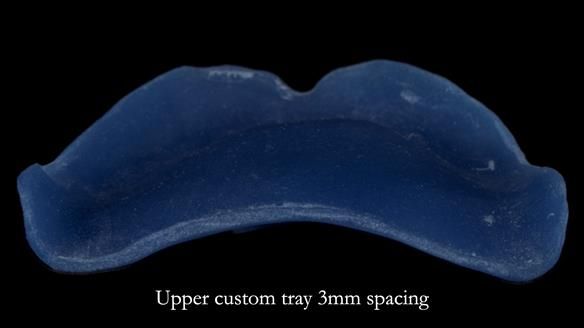 Newsletter 83: Sheila’s Complete Denture Success