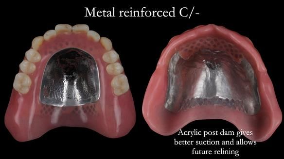 Newsletter 50 Special edition Complete Dentures FULL PROTOCOL