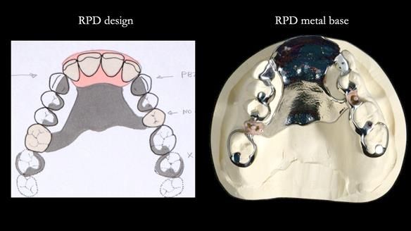 Newsletter 81 - Pam’s Story — how a partial denture changed her life (+ live walkthrough this Thursday)