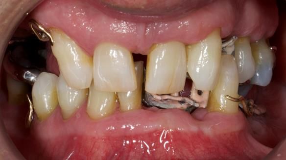 Newsletter 86 Peter the Architect — precision removable partial dentures case study