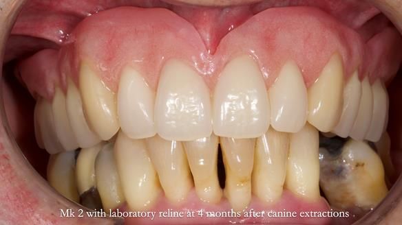 Newsletter 77: Jeremy’s case – immediate complete upper denture