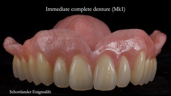 Newsletter 77: Jeremy’s case – immediate complete upper denture