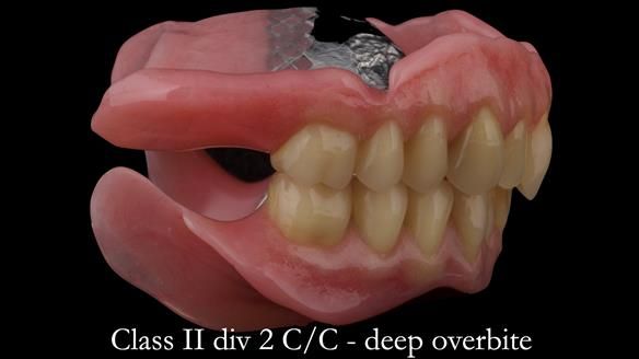 Complete denture Class II div 2 deep overbite Newsletter 39