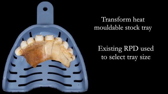 Newsletter 52 Managing Jo’s failing dentition with extractions and Mk 1/Mk 2 complete upper dentures and lower partial dentures FULL PROTOCOL