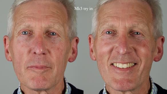 Newsletter 77: Jeremy’s case – immediate complete upper denture