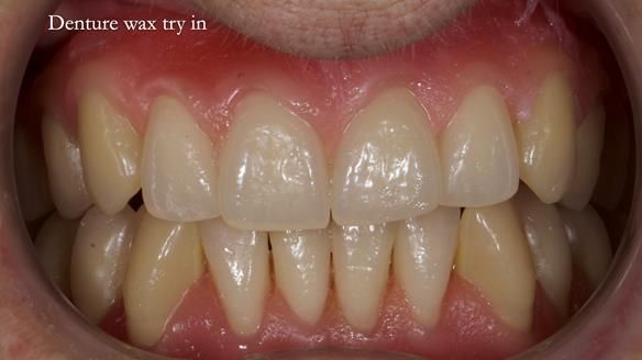 Newsletter 83: Sheila’s Complete Denture Success