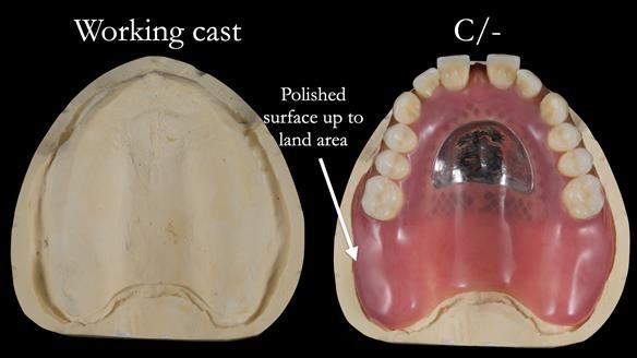 Newsletter 53 showing the making and fitting of ultra life-like dentures for Valena