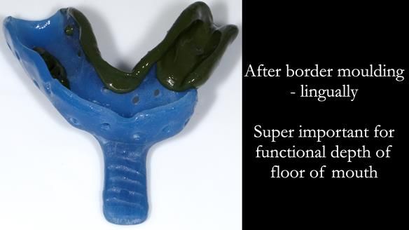 Finlay's Newsletter 61 provision of a lower unilateral free end saddle metal based partial denture for Joyce