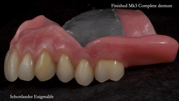 Newsletter 77: Jeremy’s case – immediate complete upper denture