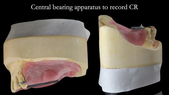 Finlay's Case Study Newsletter 40 - Immediate Mk 1 RPD to Definitive Mk 2 RPD - full protocol