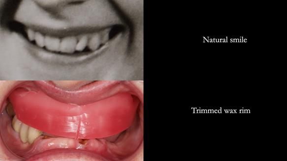 Newsletter 82 Mary - A complete upper and a one-tooth gasket denture