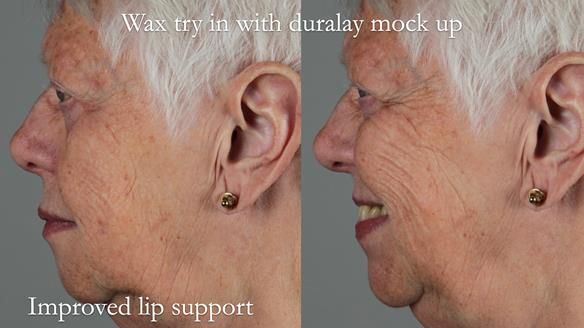 Finlay's Newsletter 59 Ultra hard partial dentures made for Gill