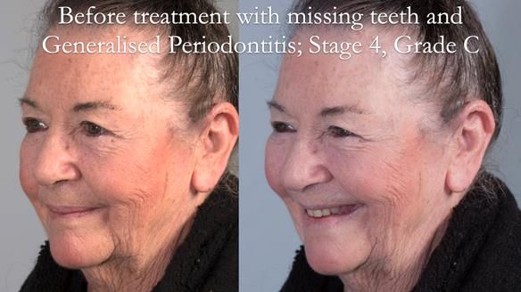 Finlay's Case Study Newsletter 40 - Immediate Mk 1 RPD to Definitive Mk 2 RPD - full protocol