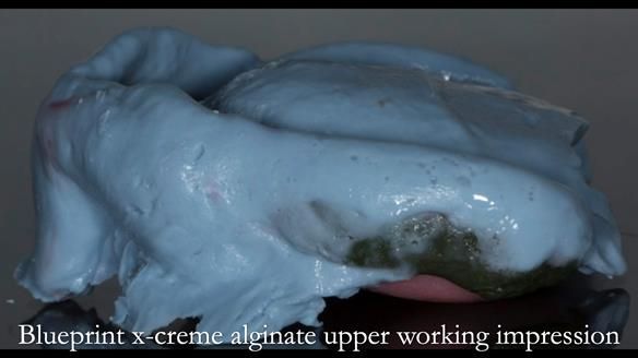 Newsletter 75: Marion’s case - Step-by-step complete denture workflow