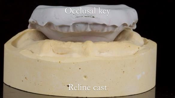 Finlay's Newsletter 62 provision of extractions and metal based complete dentures for Rafique