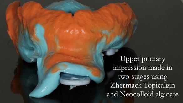 Complete denture Class II div 2 deep overbite Newsletter 39