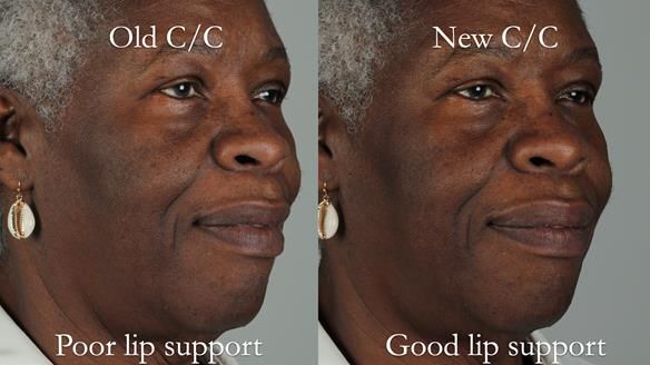 Newsletter 53 showing the making and fitting of ultra life-like dentures for Valena