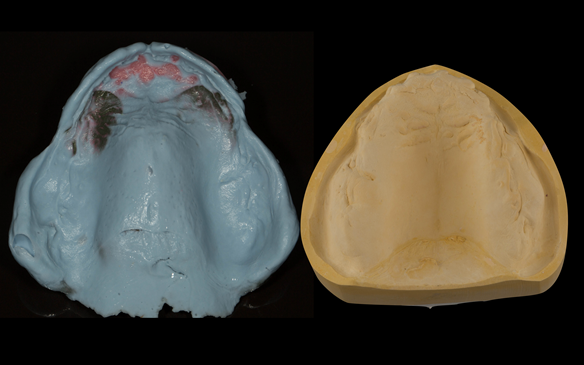 Figure 78 Definitive impression made in alginate (Blueprint) with resultant poured definitive cast