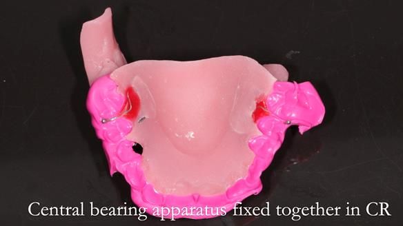 Newsletter 54 case presentation upper complete denture and lower Scandinavian designed hygienic partial denture for David