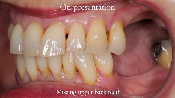 Newsletter 56 showing the making and fitting of a bilateral free end saddle upper removable partial denture (RPD) for patient with pemphigus