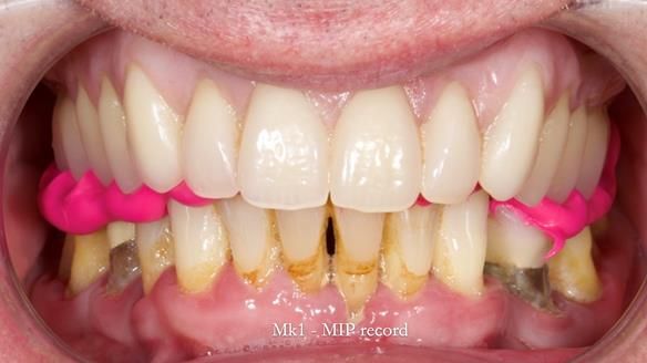 Newsletter 77: Jeremy’s case – immediate complete upper denture