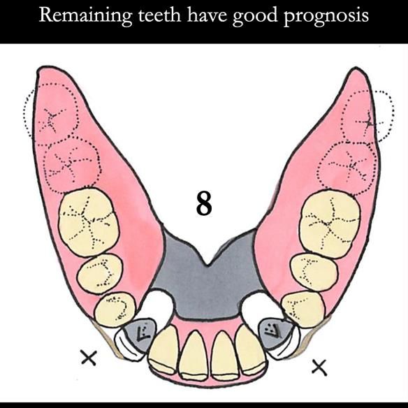 Universal Scandinavian partial denture designs