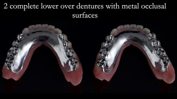 Newsletter 44 - extreme removable prosthodontics – engineering a super-strong and ultra-thin over denture