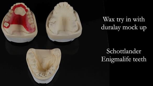 Finlay's Newsletter 60 Sylvia's upper Kennedy Class 2 Mod 1 metal based upper RPD