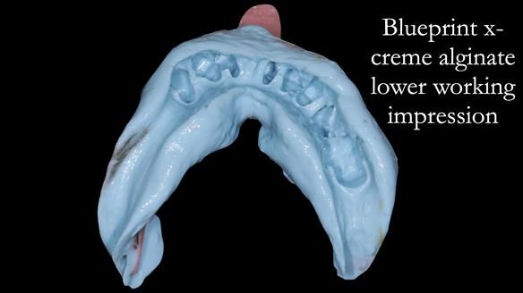 Newsletter 54 case presentation upper complete denture and lower Scandinavian designed hygienic partial denture for David