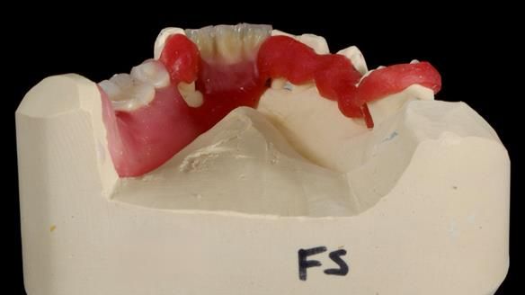 Newsletter 86 Peter the Architect — precision removable partial dentures case study