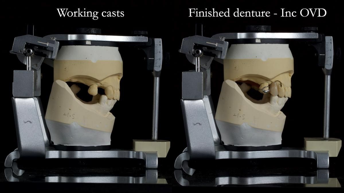 Newsletter 89 – Simon: A Challenging Kennedy Class II Division 1 Upper CoCr Partial Denture with a High Smile Line