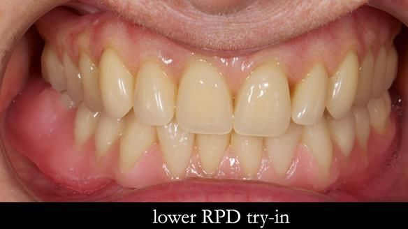 Newsletter 82 Mary - A complete upper and a one-tooth gasket denture