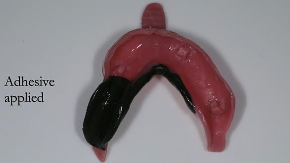 Newsletter 54 case presentation upper complete denture and lower Scandinavian designed hygienic partial denture for David