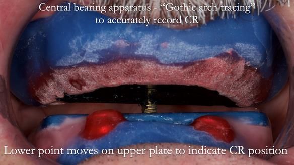 Newsletter 78: What do Clark Gable and a Locator® overdenture have in common?