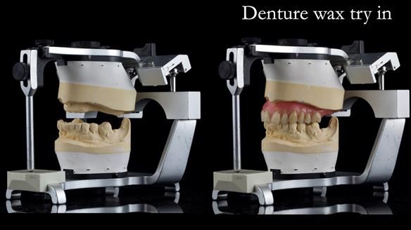 Newsletter 54 case presentation upper complete denture and lower Scandinavian designed hygienic partial denture for David