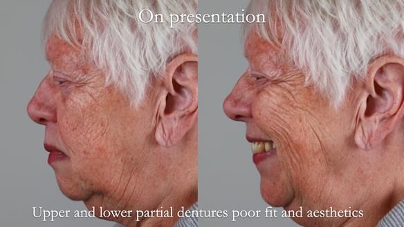 Finlay's Newsletter 59 Ultra hard partial dentures made for Gill