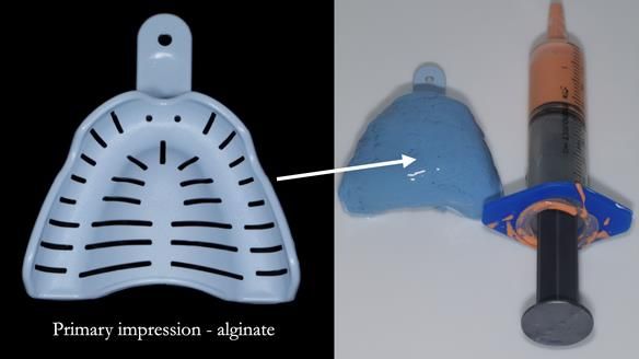 Newsletter 77: Jeremy’s case – immediate complete upper denture