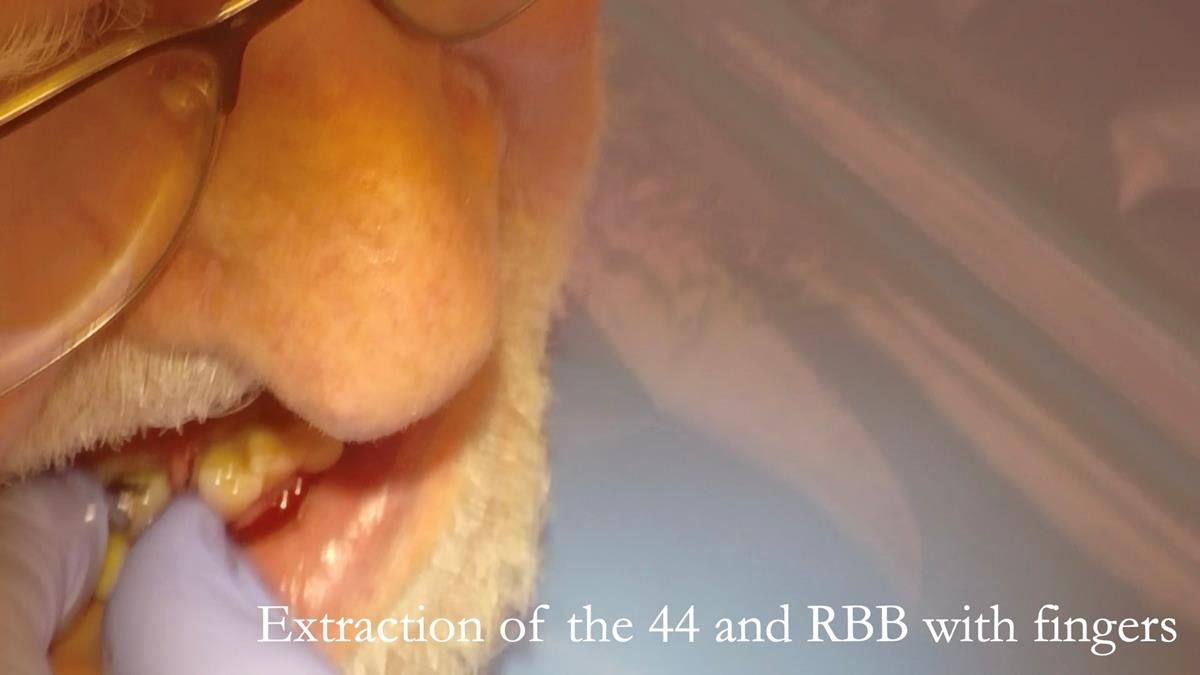 Newsletter 87 – Father Peter: A Partial Denture that needed Minor Miracle
