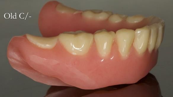 Complete denture Class II div 2 deep overbite Newsletter 39