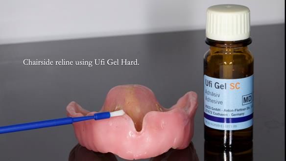 Newsletter 77: Jeremy’s case – immediate complete upper denture