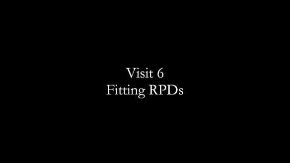Newsletter 86 Peter the Architect — precision removable partial dentures case study